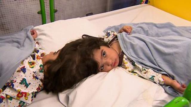 Two Brains, One Skull - Separating Conjoined Twins