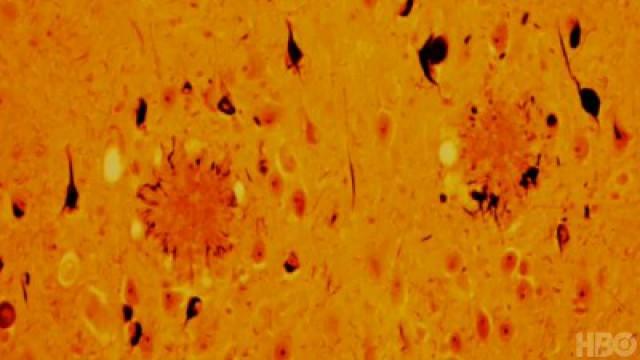 Understanding And Attacking Alzheimer's