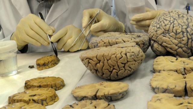 Alzheimer-Krankheit - Wird sie bald heilbar sein?