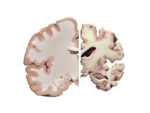 Alzheimer's and the Brain