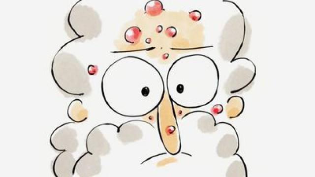 Acne vulgaris