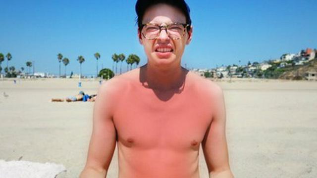 I got sunburnt...