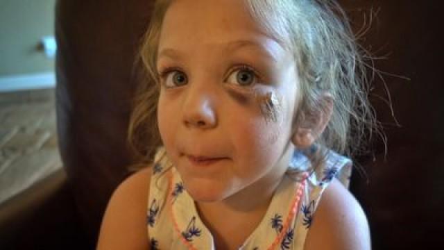 Annie's Worst Injury Yet...
