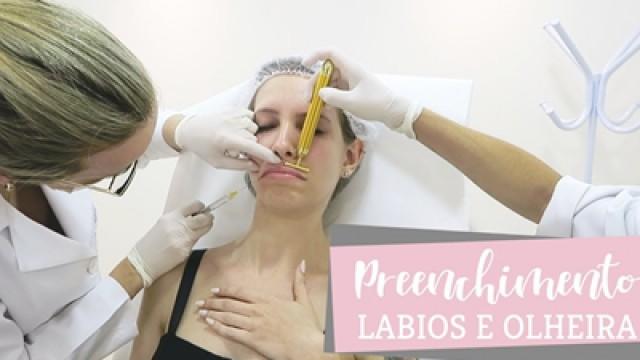 Preenchimento olheiras e lábio - ANTES E DEPOIS