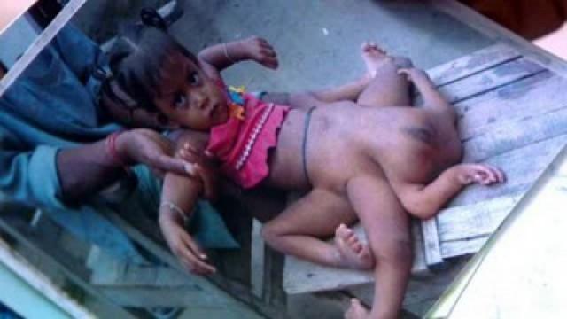 The Girl With 8 Limbs