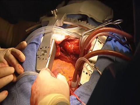 Open Heart Surgery