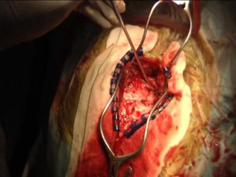 Awake Brain Surgery