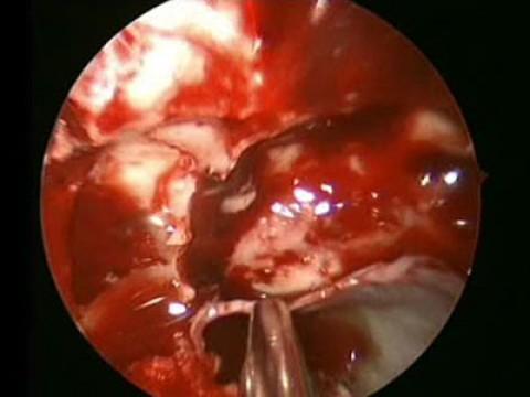 Pituitary Tumour Removal