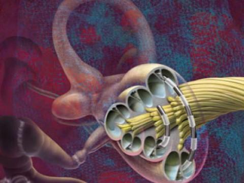 Cochlea-Implantat: Wie Natalie hören lernte