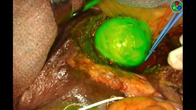 Cutting-Edge Cancer Treatments: Fluorescence-Guided Surgery