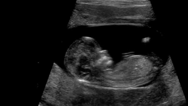 Stages of Human Embryo Development - أطوار الجنين