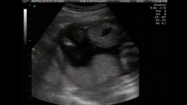 3D/4D Gender Ultrasound at 18 Weeks!