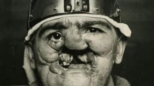L’histoire tragique des « Gueules Cassées », martyrs de la Grande Guerre