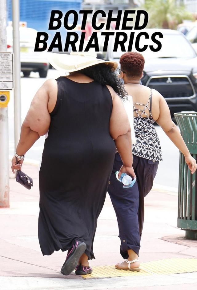 Botched Bariatrics