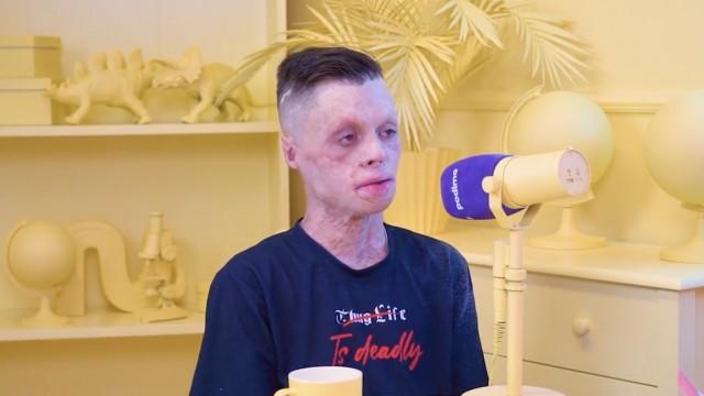 ¿Cómo es sobrevivir a las llamas y vivir con el 90% del cuerpo quemado?