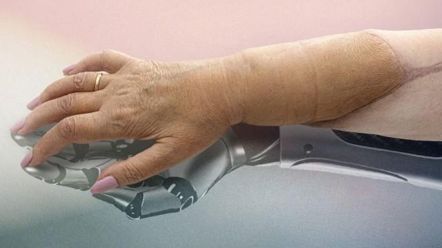 La mano de Arja - Historia de un transplante